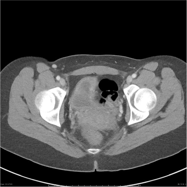 File:Bilateral ureteritis and cystitis (Radiopaedia 25340-25594 A 72).jpg