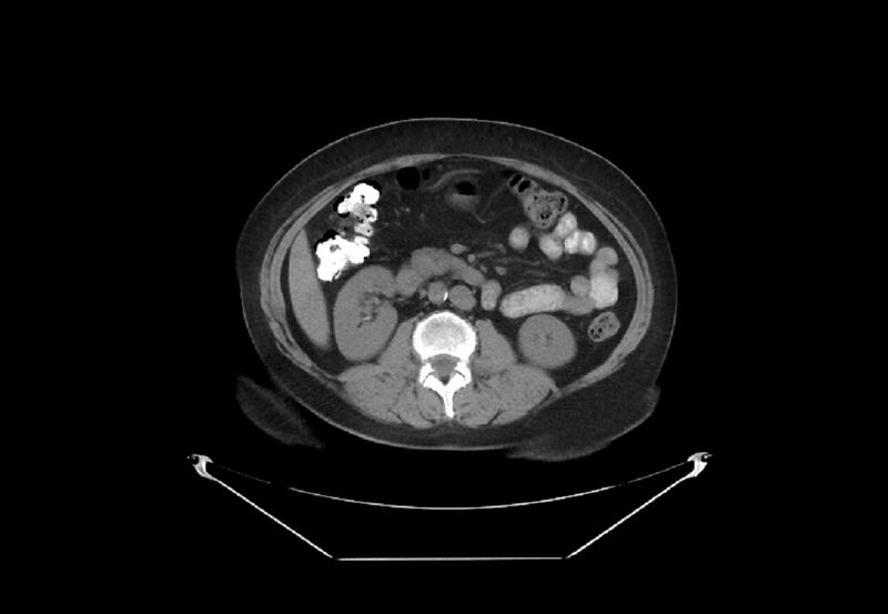File:Bilateral urolithiasis with incidentally detected splenic artery aneurysm and left inferior vena cava (Radiopaedia 44467-48123 Axial non-contrast 25).jpg