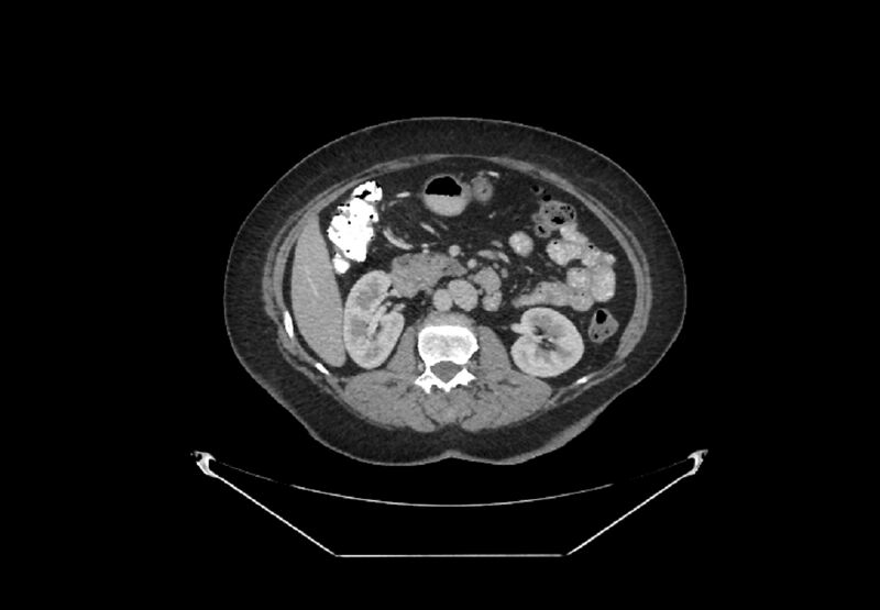 File:Bilateral urolithiasis with incidentally detected splenic artery aneurysm and left inferior vena cava (Radiopaedia 44467-48127 B 44).jpg