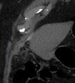 Bile leak from accessory duct(s) of Luschka post cholecystectomy (Radiopaedia 40736-43389 B 8).jpg