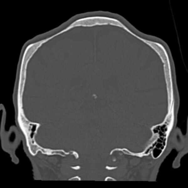File:Biparietal osteodystrophy (Radiopaedia 46109-50463 Coronal bone window 72).jpg