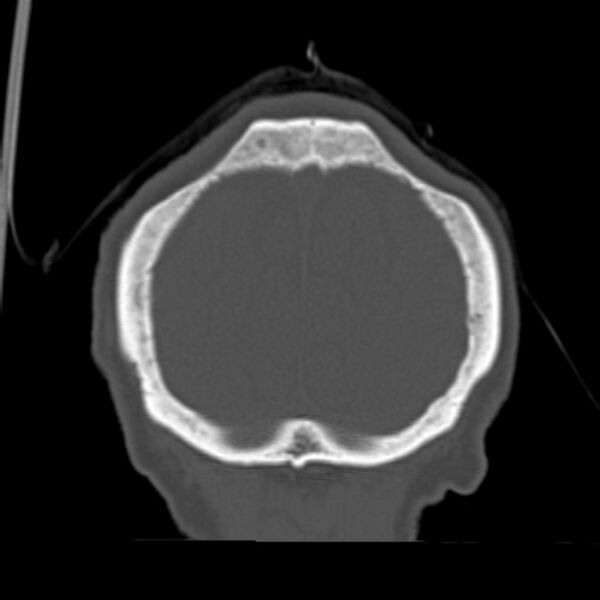 File:Biparietal osteodystrophy (Radiopaedia 46109-50463 Coronal bone window 94).jpg
