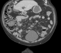 Bladder papillary urothelial carcinoma (Radiopaedia 48119-52951 C 22).png