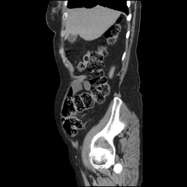 File:Bladder tumor detected on trauma CT (Radiopaedia 51809-57609 E 59).jpg