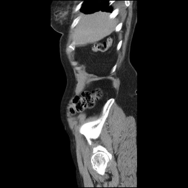File:Bladder tumor detected on trauma CT (Radiopaedia 51809-57609 E 64).jpg
