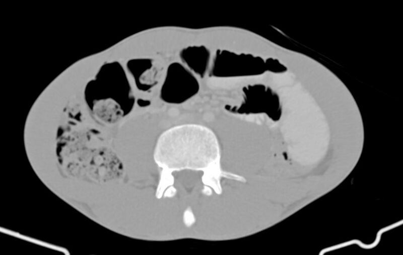 File:Blunt injury to the small bowel (Radiopaedia 74953-85987 Axial Wide 57).jpg