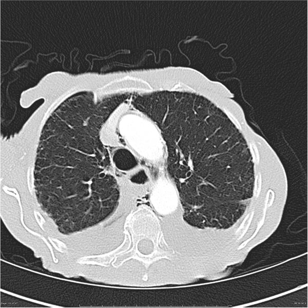 File:Boerhaave syndrome (Radiopaedia 26240-26362 Axial lung window 15).jpg
