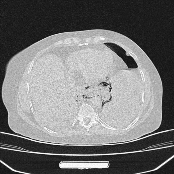 File:Boerhaave syndrome (Radiopaedia 45644-49799 Axial lung window 86).jpg