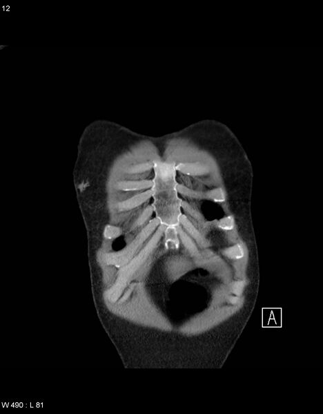 File:Boerhaave syndrome with tension pneumothorax (Radiopaedia 56794-63605 B 1).jpg