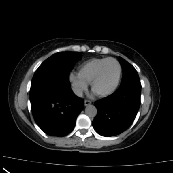 File:Bosniak renal cyst - type I (Radiopaedia 27479-27675 Axial non-contrast 2).jpg