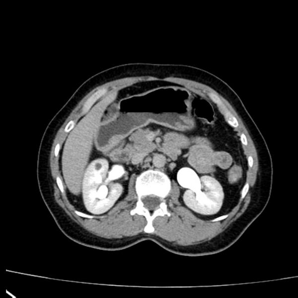 File:Bosniak renal cyst - type I (Radiopaedia 27479-27675 D 15).jpg