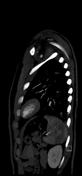 File:Brachiocephalic trunk pseudoaneurysm (Radiopaedia 70978-81191 C 76).jpg