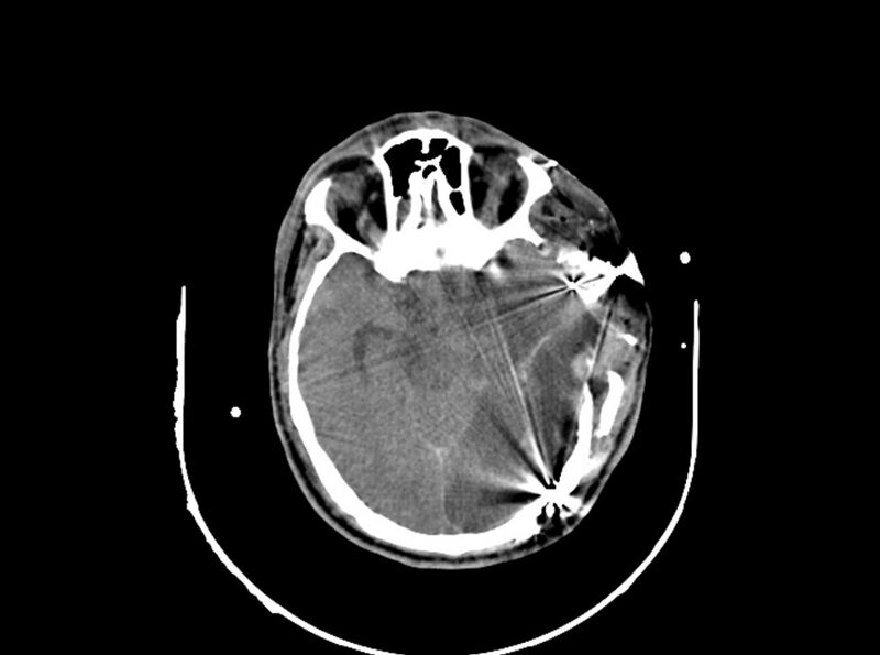 File:Brain injury by firearm projectile (Radiopaedia 82068-96087 B 89).jpg