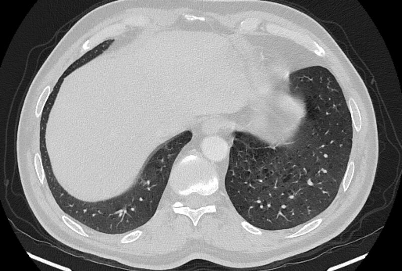 File:Brain metastases - lung cancer primary (Radiopaedia 75060-86116 Axial lung window 51).jpg