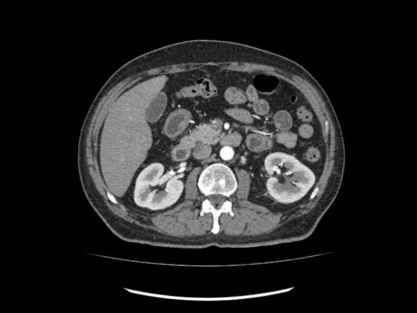 Brain metastases from renal cell carcinoma (Radiopaedia 42222-45328 A 89).jpg