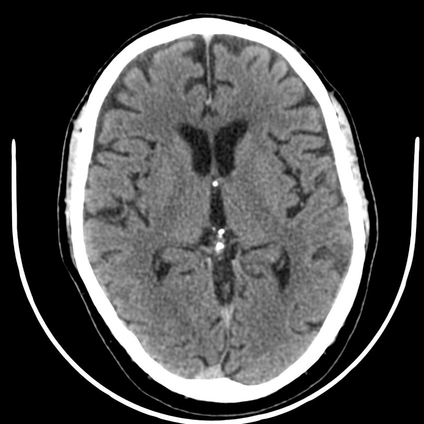 Brain metastasis (Radiopaedia 42617-45760 Axial non-contrast 23).jpg