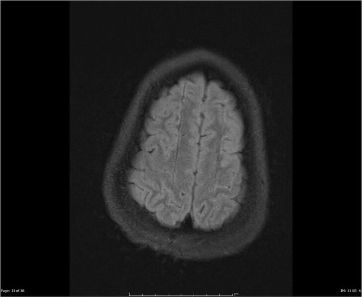 File:Brainstem glioma (Radiopaedia 21819-21775 Axial FLAIR 33).jpg