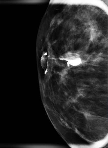 File:Breast duct diverticulum (Radiopaedia 19032-18992 Galactogram- ML view 1).png