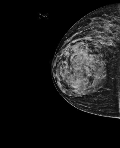 File:Breast hamartoma (Radiopaedia 63719-72417 CC 1).jpg