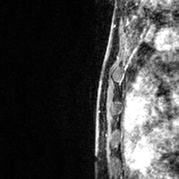 File:Breast implants - MRI (Radiopaedia 26864-27035 Sagittal T2 56).jpg