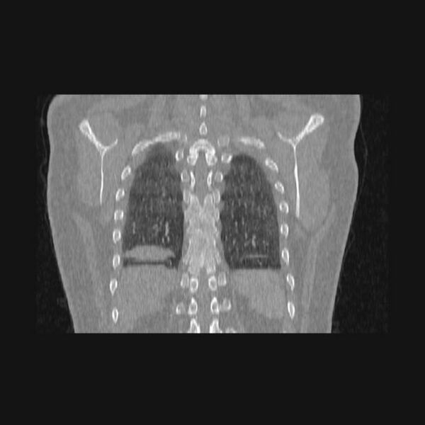 File:Bronchial atresia (Radiopaedia 60685-68439 Coronal lung window 13).jpg