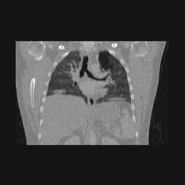 File:Bronchial atresia (Radiopaedia 60685-68439 Coronal lung window 34).jpg