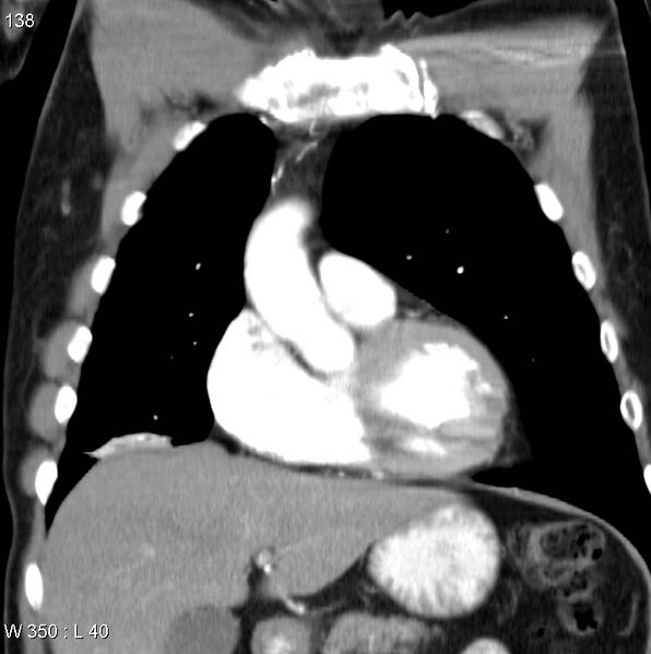 File:Bronchial carcinoid tumor with right lower lobe collapse (Radiopaedia 29060-29422 C 7).jpg