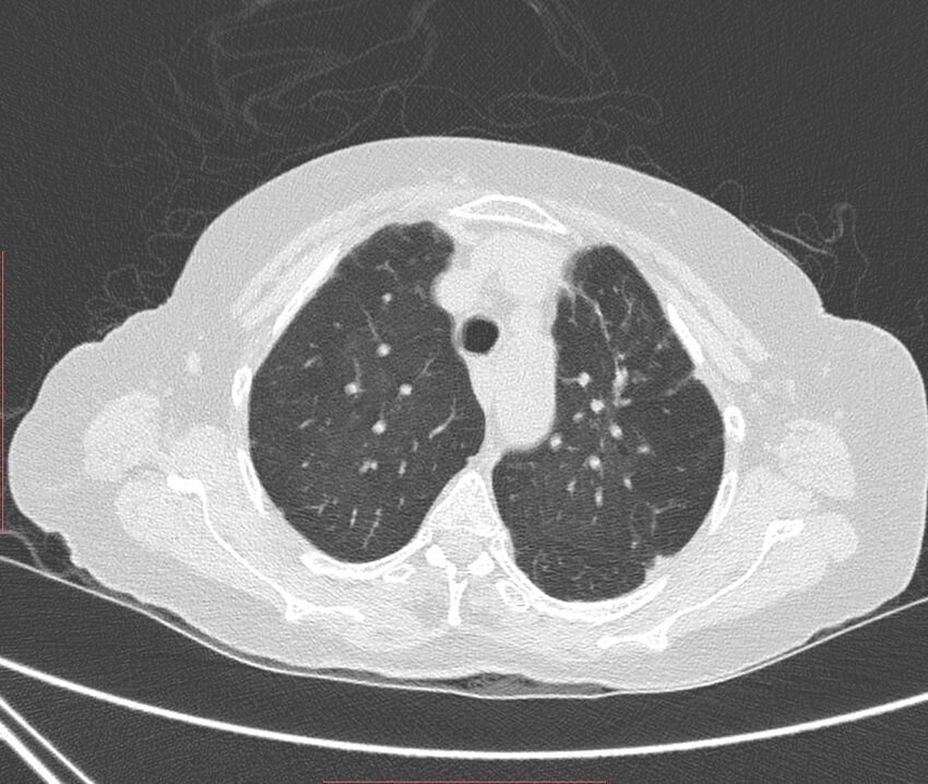 Bronchiectasis (Radiopaedia 72693-83293 Axial lung window 28).jpg
