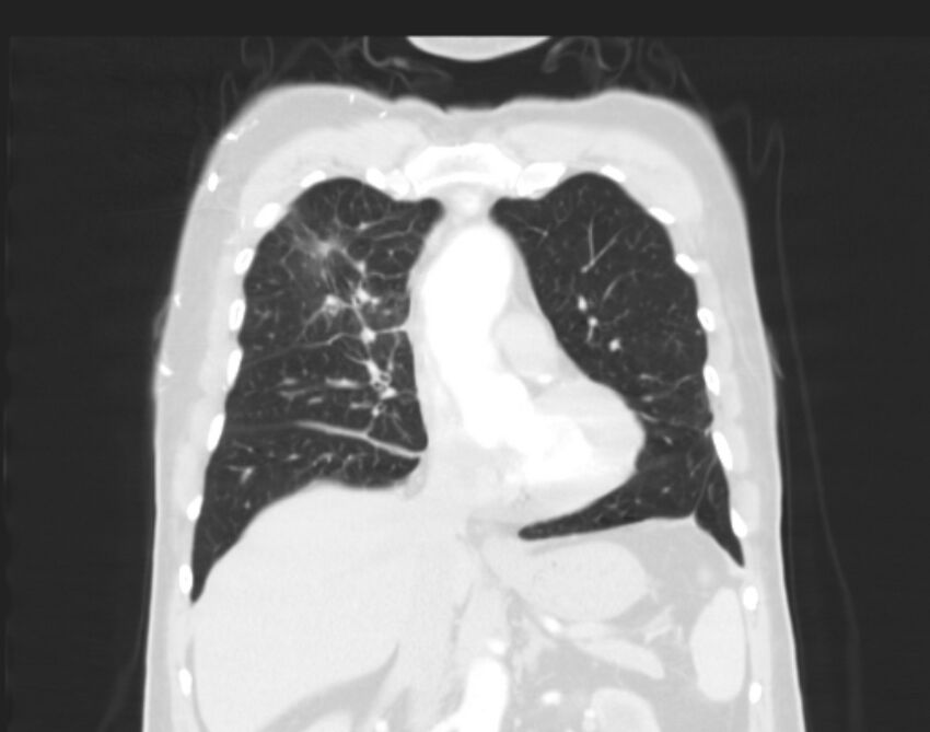 Bronchogenic carcinoma with lymphangitic spread (Radiopaedia 29002-29357 Coronal lung window 25).jpg