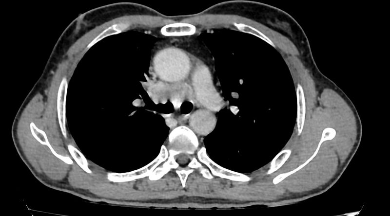 File:Bronchogenic carcinoma with superior vena cava syndrome (Radiopaedia 36497-38054 Axial C+ delayed 38).jpg