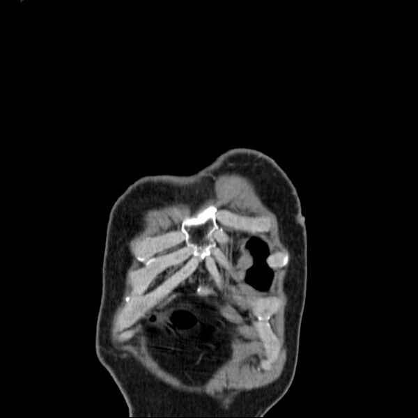 File:Bronchopleural fistula - postoperative complication (Radiopaedia 21020-20947 Coronal non-contrast 1).jpg