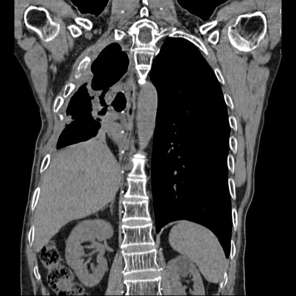 File:Bronchopleural fistula - postoperative complication (Radiopaedia 21020-20947 Coronal non-contrast 19).jpg