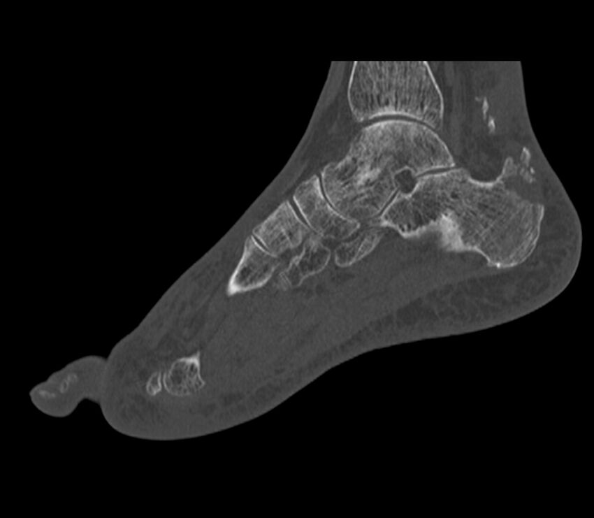 Calcaneal tuberosity avulsion fracture (Radiopaedia 22649-22668 Sagittal bone window 27).jpg