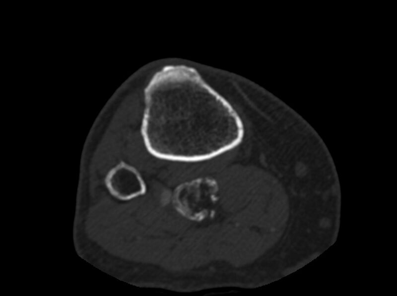 File:Calcified hematoma - popliteal fossa (Radiopaedia 63938-72763 C 88).jpg