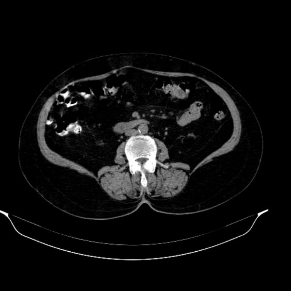 File:Calcified hydatid cyst (Radiopaedia 62000-70085 Axial non-contrast 57).jpg