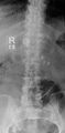 Calcified mesenteric lymph nodes (Radiopaedia 13296).jpg