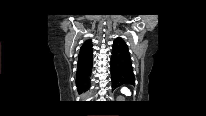 File:Calcified spleen (Radiopaedia 60952-68768 Coronal non-contrast 10).jpg