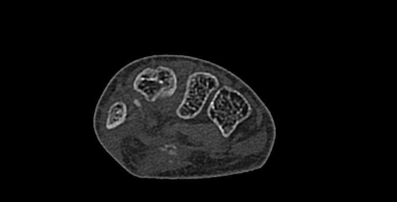 File:Calcifying aponeurotic fibroma (Radiopaedia 88423-105064 Axial bone window 108).jpg