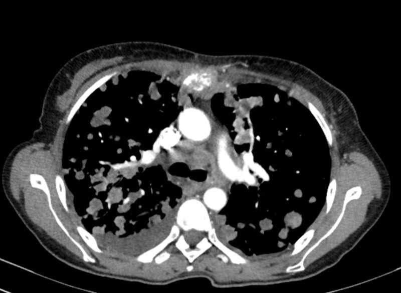 File:Cannonball metastases from breast cancer (Radiopaedia 91024-108569 A 47).jpg