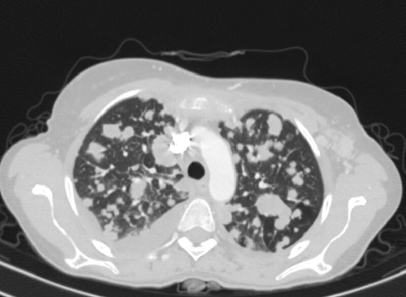 File:Cannonball metastases from breast cancer (Radiopaedia 91024-108569 Axial lung window 23).jpg