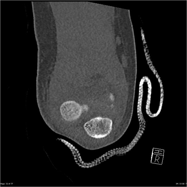 File:Capitellum fracture (Radiopaedia 23352-23426 Coronal bone window 32).jpg