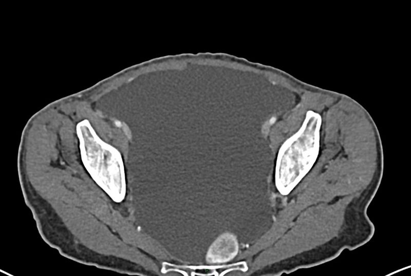 File:Carcinoid mesenteric tumor complicated by chylous ascites (Radiopaedia 76312-87953 A 67).jpg