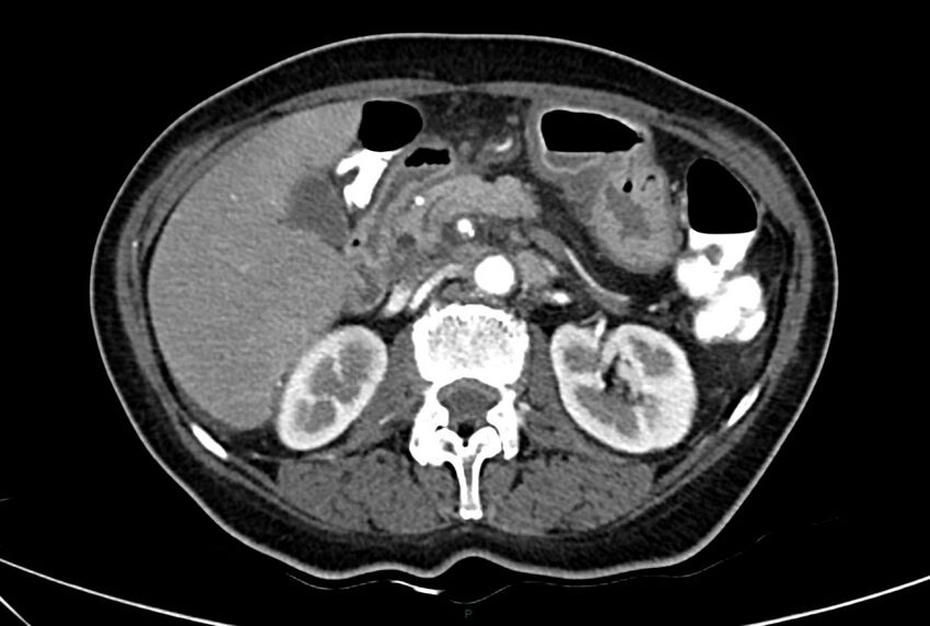 Carcinoid mesenteric tumor complicated by chylous ascites (Radiopaedia 76312-88926 A 25).jpg