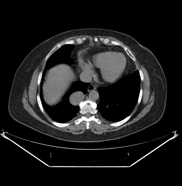 File:Carcinoid tumor - lung (Radiopaedia 44814-48646 Axial non-contrast 1).PNG