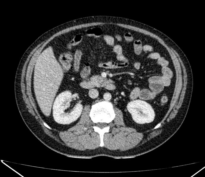 File:Carcinoid tumor with hepatic metastases (Radiopaedia 22651-22670 C 47).jpg