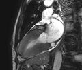 Cardiac amyloidosis (Radiopaedia 39736-42124 B 8).jpg