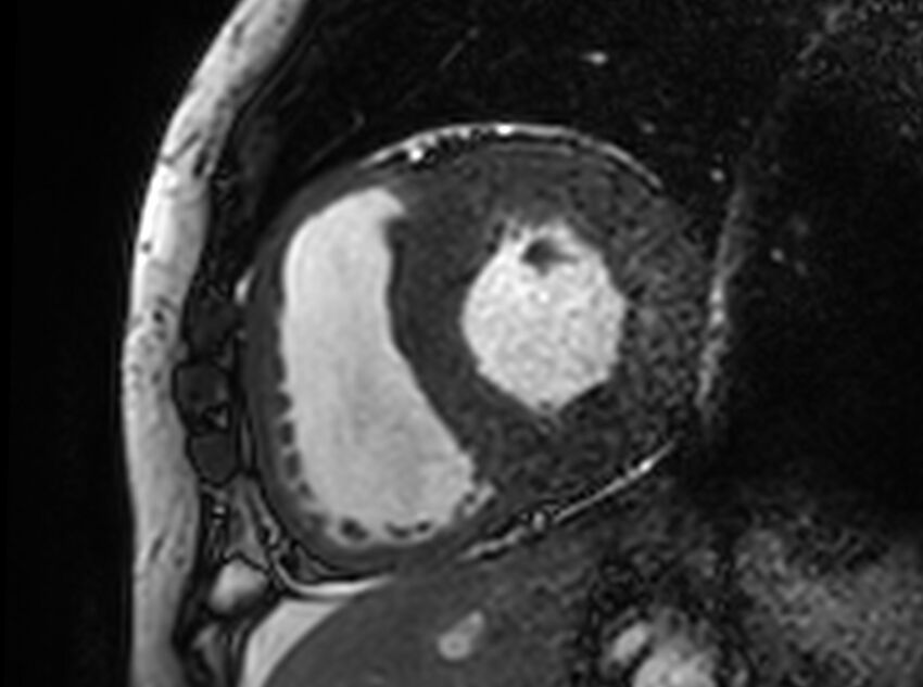 Cardiac amyloidosis (Radiopaedia 61600-69579 Short axis bSSFP 214).jpg