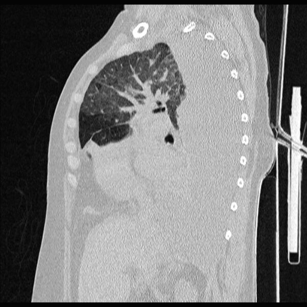 File:Cardiogenic pulmonary edema (Radiopaedia 29213-29609 Sagittal lung window 37).jpg
