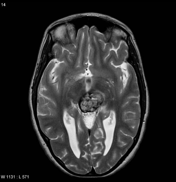 File:Cavernous malformation of the midbrain (Radiopaedia 7791-8615 Axial T2 3).jpg