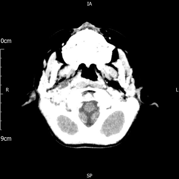 File:Cavernous sinus thrombosis (Radiopaedia 79414-92510 Axial Brain 47).jpg